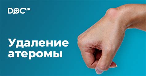 Удаление атером в Киеве: цены, отзывы, клиники | doc.ua