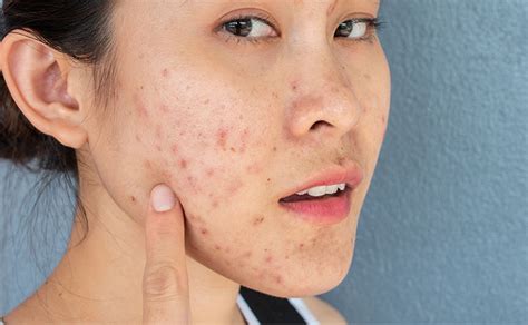 shop  effective acne skin care products  beauty barn