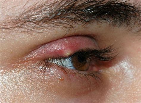 How To Treat Ingrown Eyelash (Trichiasis)? 4 Treatments