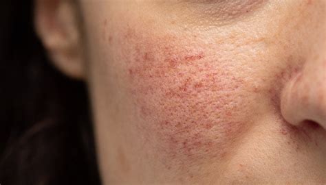 How To Treat Rosacea - Causes, Symptoms, Types – SkinKraft