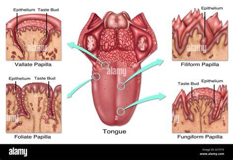 Enlarged Papillae