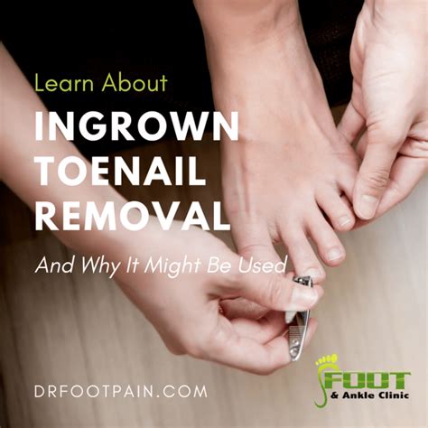 How Ingrown Toenail Removal Works - Foot and Ankle Clinic