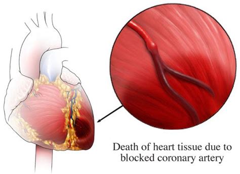 Heart Attack Blood Clot