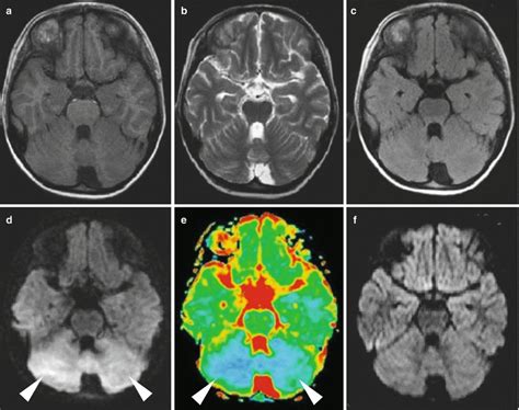 Epidemic Parotitis | Radiology Key