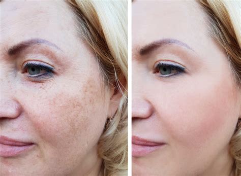 10 Effective Ways to Combat Hyperpigmentation Naturally - Filmbyen