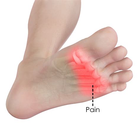 Pain In Foot At Base Of Toes at Ellen Lee blog