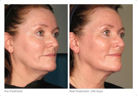Ulthera Antes E Depois - Ulthera: Passo a Passo. Com fotos Antes e Depois - Clínica Weiss