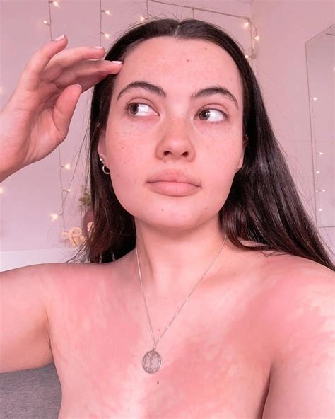 Woman allergic to water explains how she’s able to live with extremely