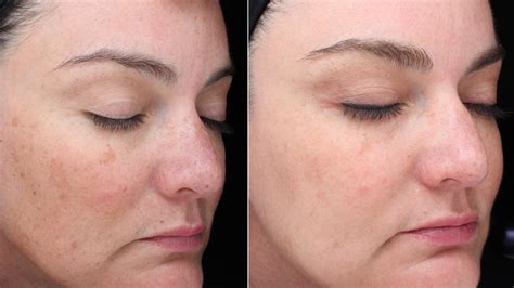 Learn The Difference: Freckles Vs Sunspots – How To Tell Which You Have ...