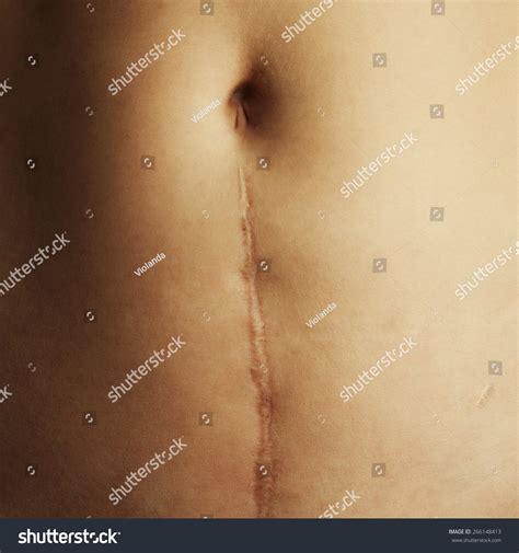 Scar On His Stomach After Surgery Stock Photo 266148413 | Shutterstock