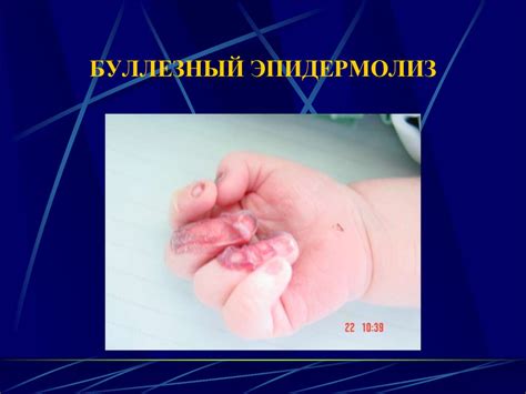 Соединительно-тканные дисплазии - презентация онлайн