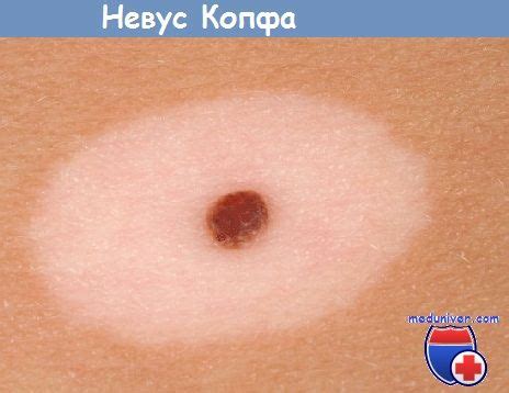 Пигментный невус. Причины возникновения невуса, классификация, лечение ...