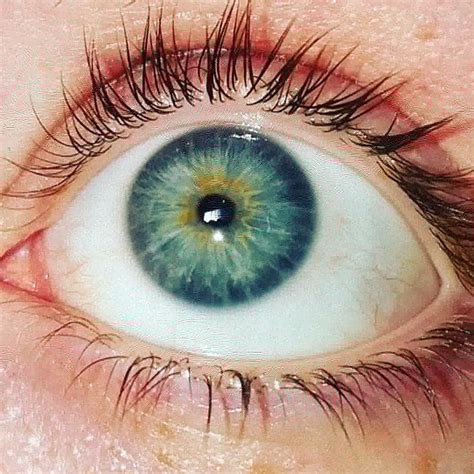 sectoral heterochromia blue  green