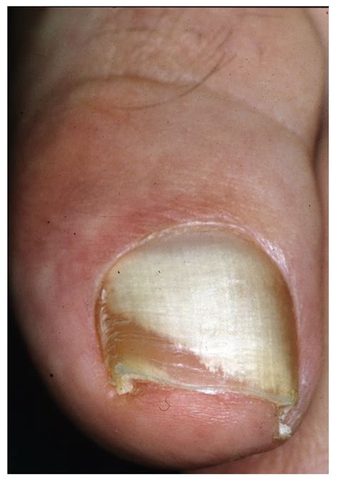 Proximal Subungual Onychomycosis