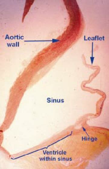 This section across one of the two coronary sinuses of the aortic valve ...