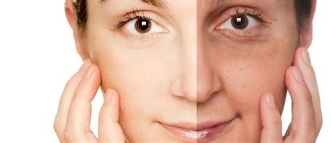 Expigment отбеливающий крем от пигментных пятен