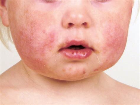 Gianotti-Crosti Syndrome: Causes, Symptoms, Treatment