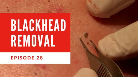 The Future of Skin Care? Unbelievable Blackhead Removal 2024 Explained - vdq0r4a