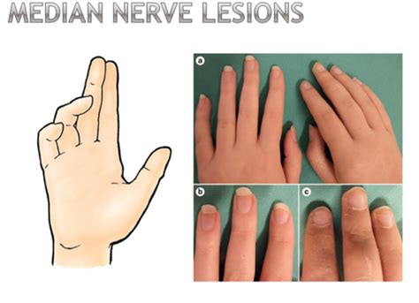 PNS Tx: FT400: Class 4 - Median Nerve Palsy & Carpal Tunnel Syndrome ...