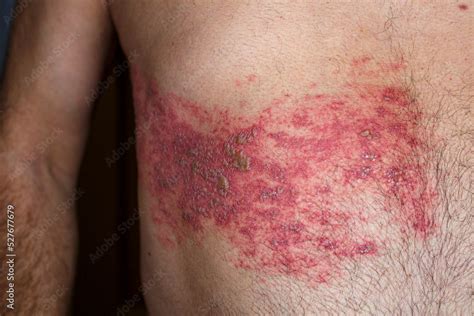 herpes zoster outbreaks  william fellows blog