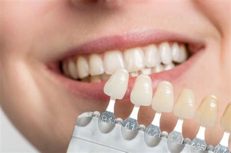 Teeth Veneers Procedure