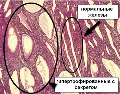 Гиперплазия поджелудочной железы