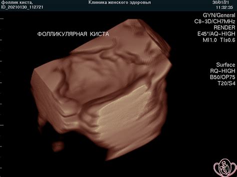 Фолликулярная киста яичника на узи фото
