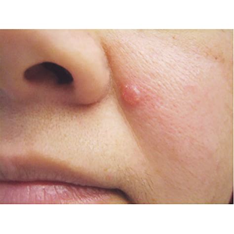 Skin Neoplasms Market Size, Trends, Industry Statistics and Latest ...