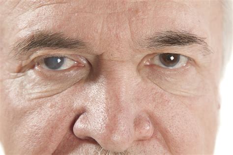Understanding the 3 Different Types of Cataracts | Campbell Cunningham ...