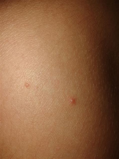 Are these the start of warts on my leg or something else? : r/Warts