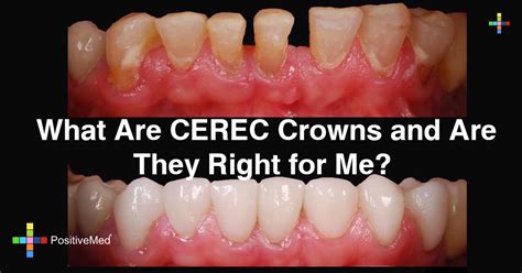 What Are CEREC Crowns and Are They Right for Me? - PositiveMed