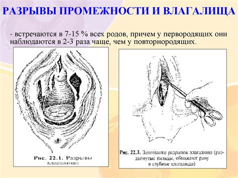 Акушерлік травматизм - презентация онлайн