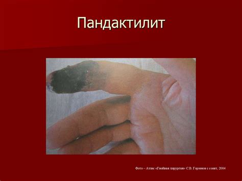 Гнойные заболевания кожи и подкожной клетчатки. Фурункул, карбункул ...
