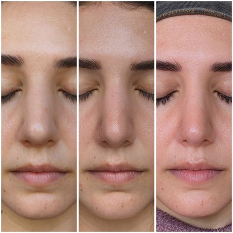 Rhinoplasty Swelling Progression, Front View : r/PlasticSurgery