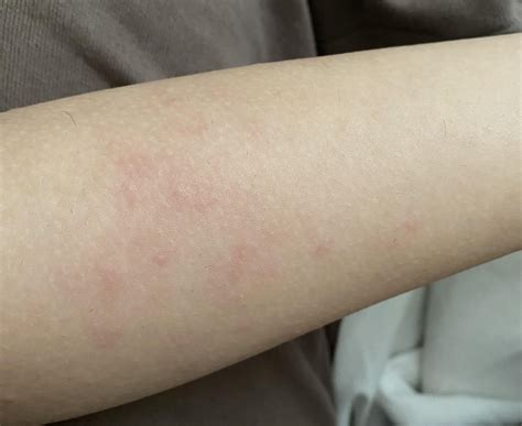 Itchy arms 😭 : r/HairRemoval