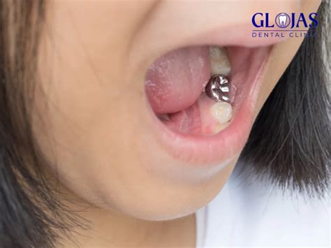 5 Amazing Benefits Of Tooth Sealant For Cavity-Free Smiles