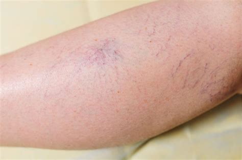 Understanding Spider Veins: Causes and Risk Factors