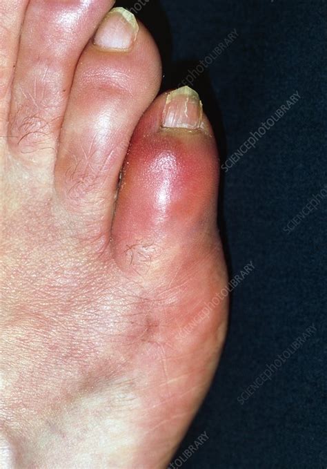 Swollen painful toe no injury - naxremonitor