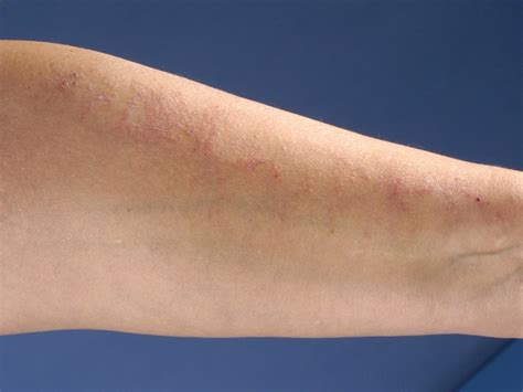 liquen estriado    causas sintomas  tratamentos blog da saude