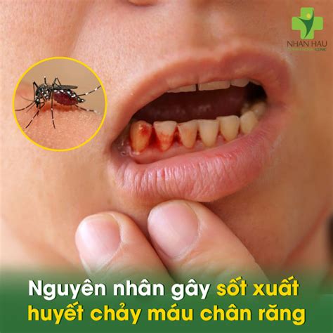 Bệnh Sốt Xuất Huyết Chảy Máu Chân Răng: Triệu Chứng, Nguyên Nhân và ...