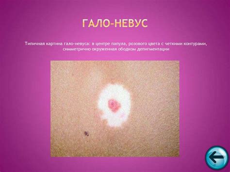 Меланоформный невус: признаки, фото, лечение, причины появления