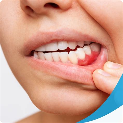 gingivitis smile  day dentistry