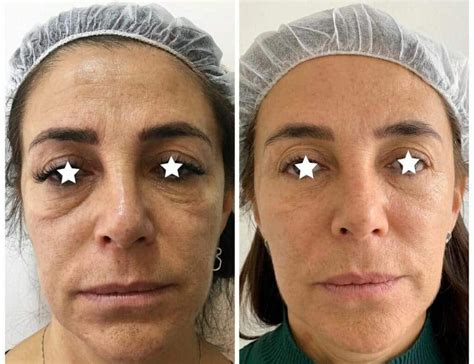 Como Funciona O Bioestimulador De Colágeno