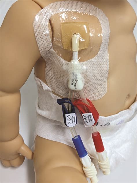 Haemodialysis Line (Permcath) - Leeds Teaching Hospitals NHS Trust