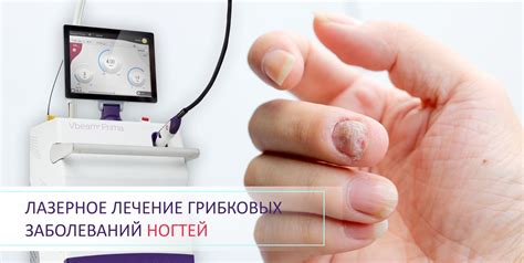 Лазерное лечение грибковых заболеваний ногтей