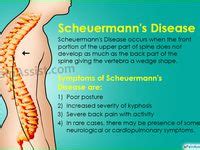 Scheuermann's Disease