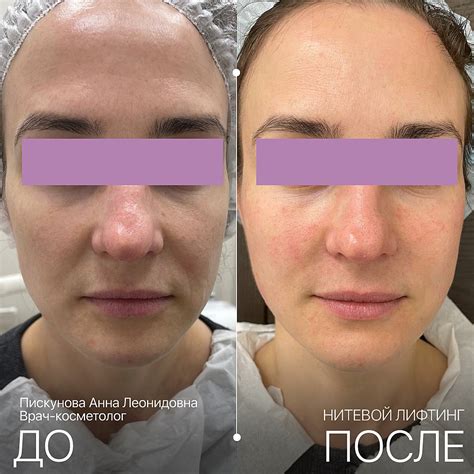 Нитевой лифтинг лица в Санкт-Петербурге - цены в Институте красоты ...