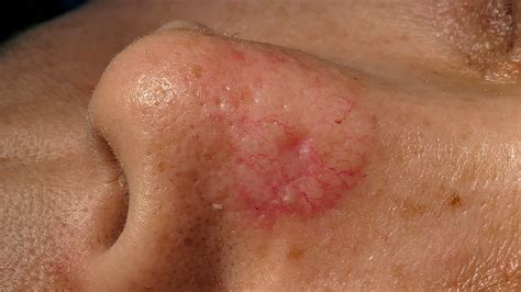 skin cancer  face images vrogueco