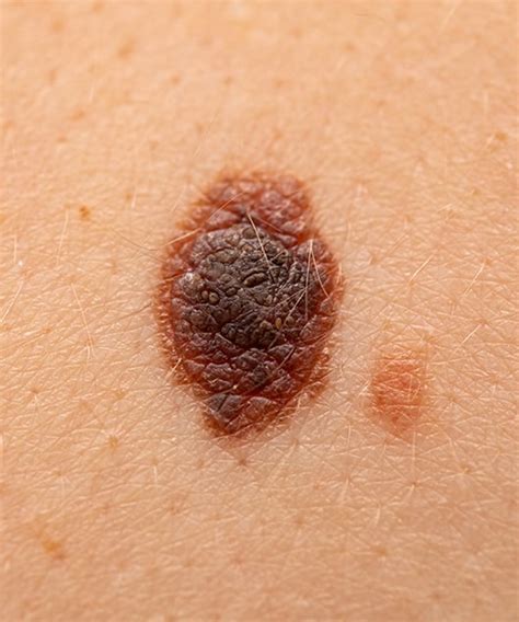 Dermatološka onkologija — Poliklinika 3DERM
