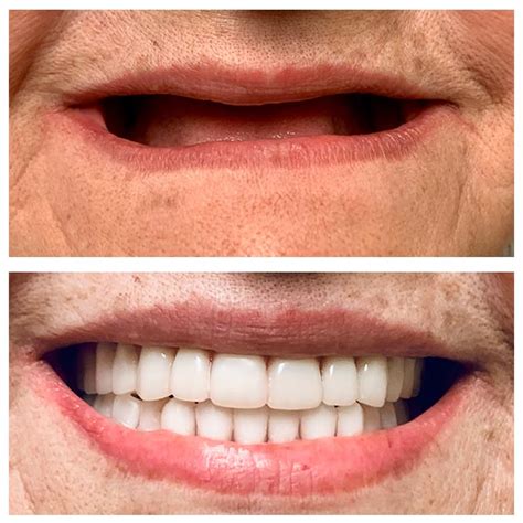 complete dentures